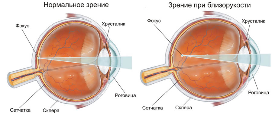 Упражнения для глаз при близорукости