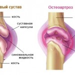 остеоартроз