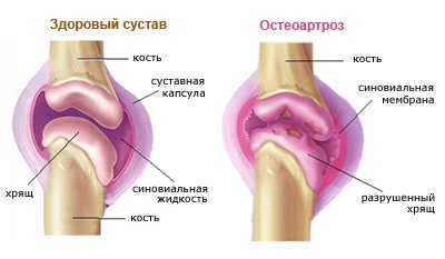 остеоартроз