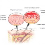 Пищевая аллергия и атопический дерматит