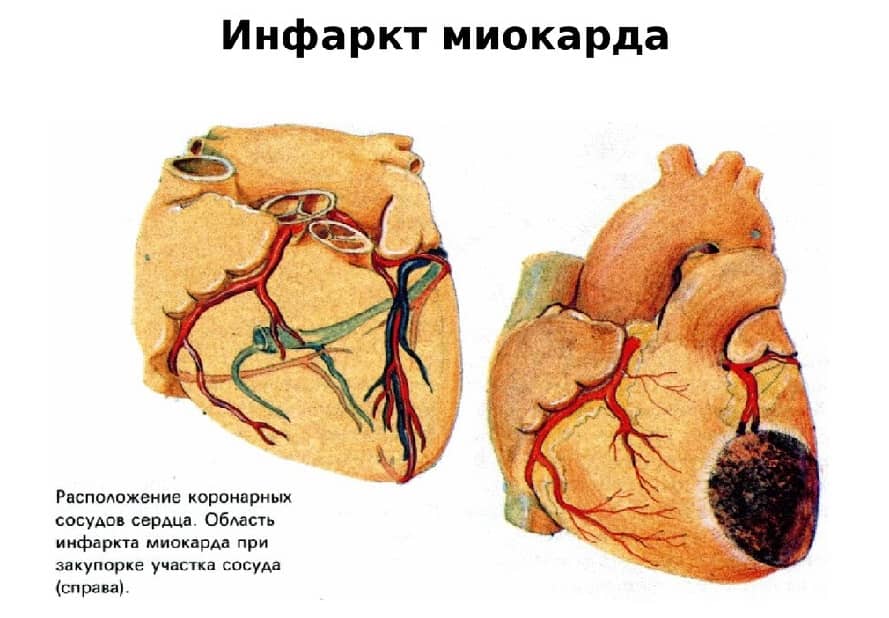 инфаркт миокарда