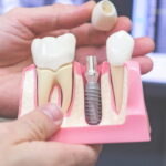 Как проходит процедура имплантации и куда обратиться за восстановлением зубов в Сургуте