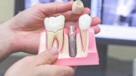 макет имплантации зубов