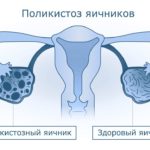 Диагностика СПКЯ основывается